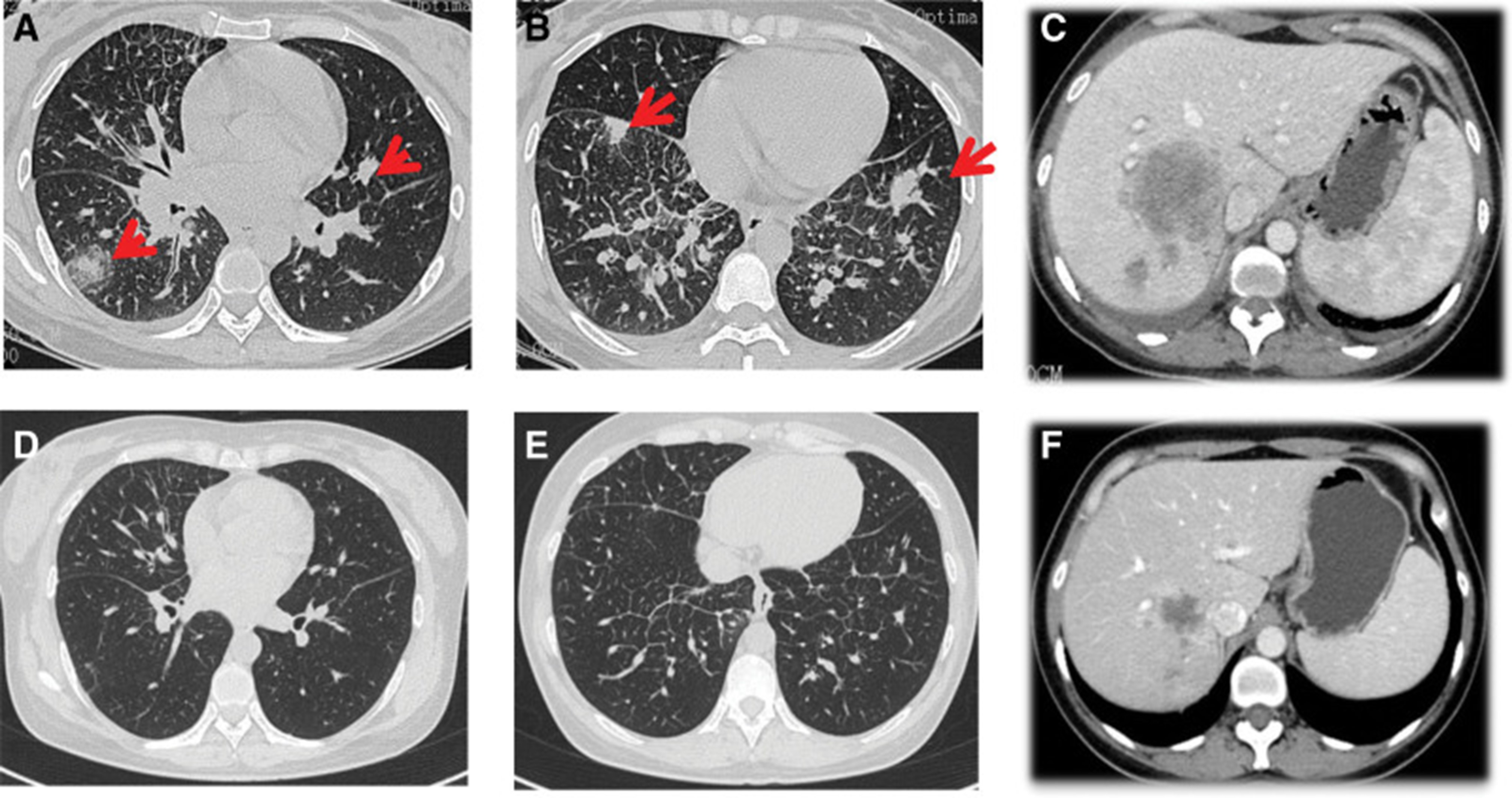 【佳学基因检测】基因检测具有ALK 融合突变而且是高 PD-L1 表达的晚期肺腺癌患者 ALK-TKI 靶向药物治疗